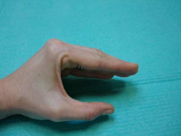 Posición funcional de inmobilización de las articulaciones MTCF, IFP e IFD