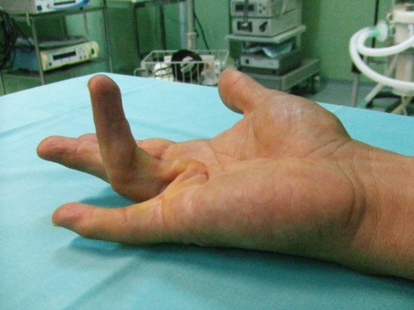 Enfermedad de Dupuytren 